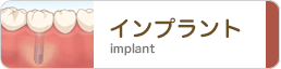 インプラント